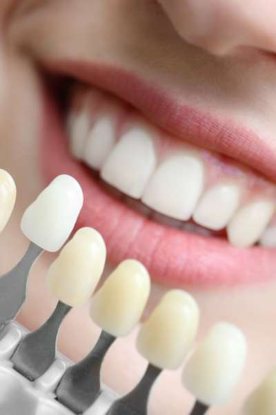 BLANQUEAMIENTO DENTAL